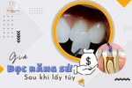 Giá Bọc Răng Sứ Sau Khi Lấy Tủy