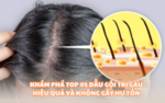 dầu gội trị gàu